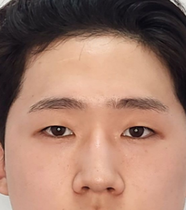 시술 전