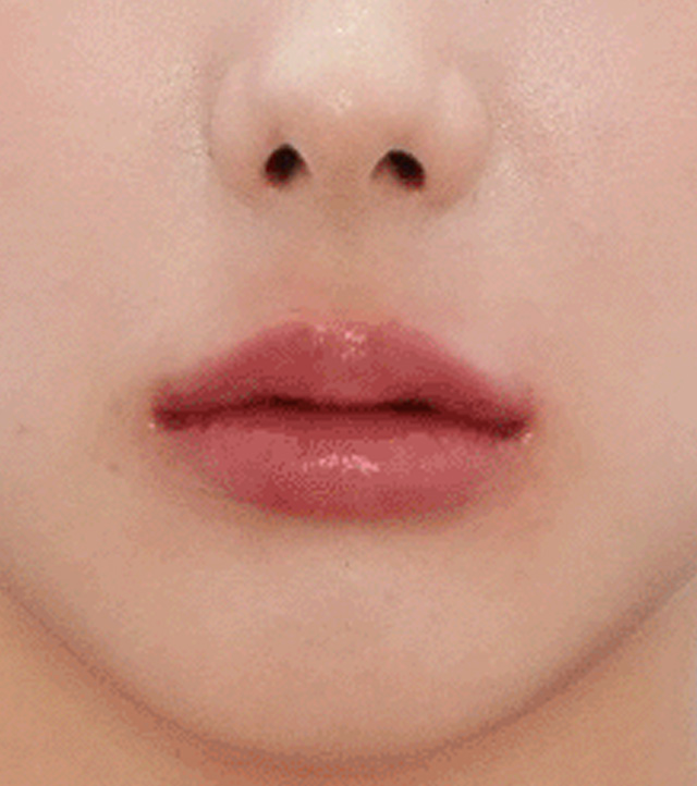 시술 후