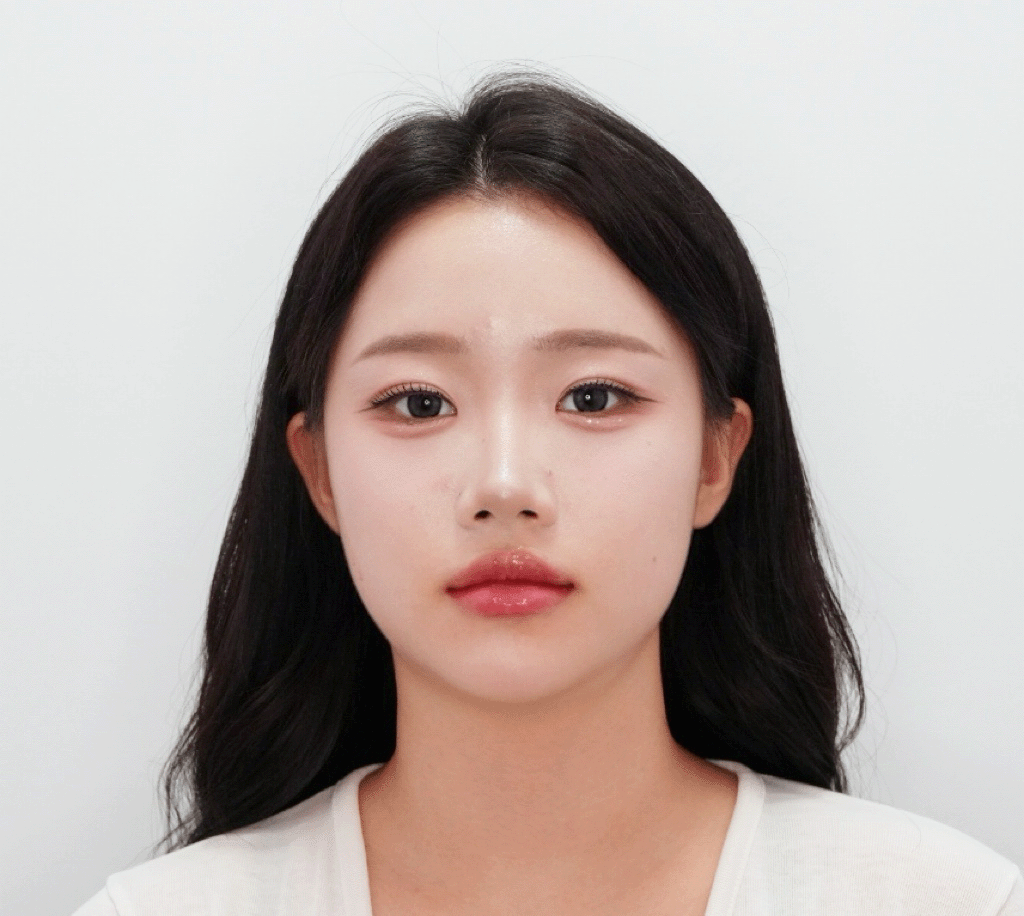 시술 후