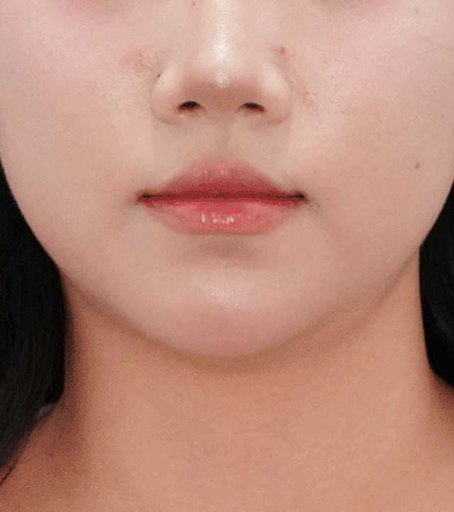 시술 전
