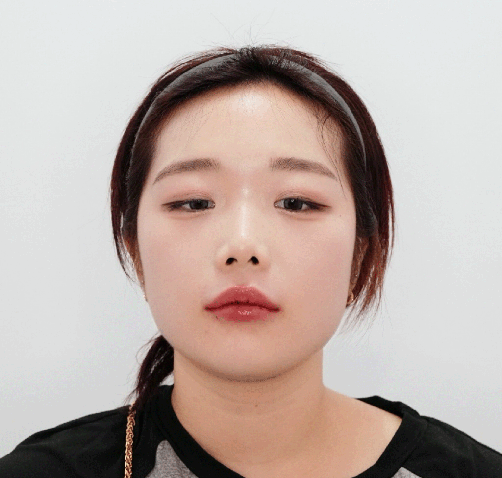 시술 후