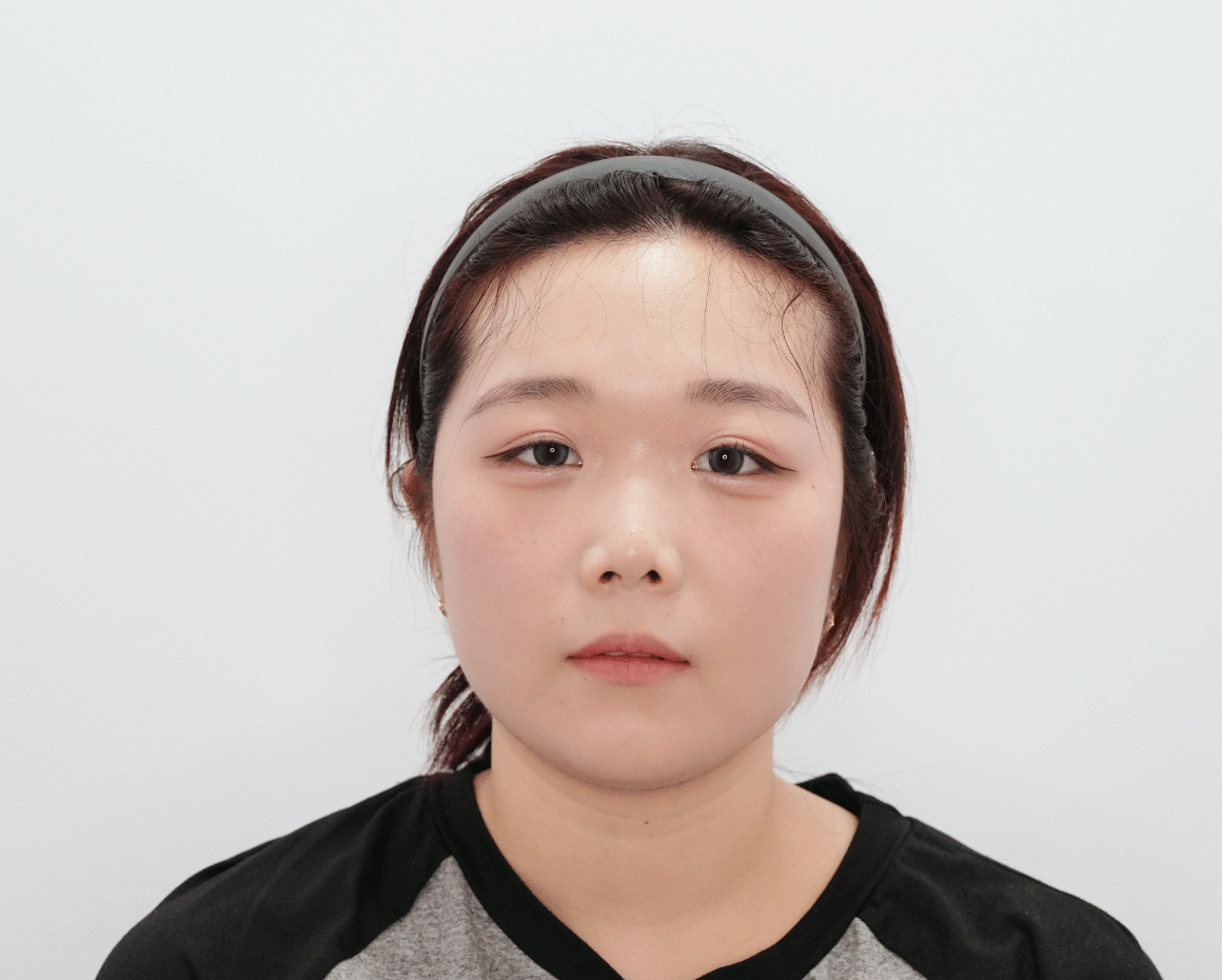 시술 전