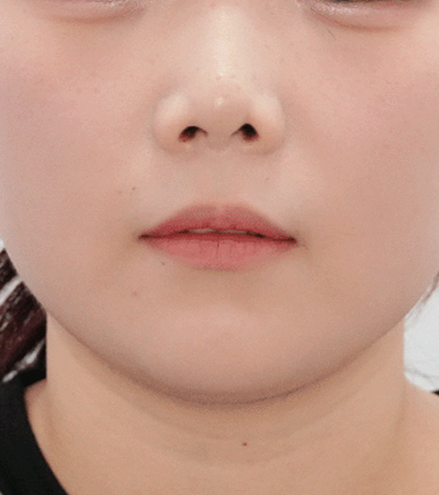 시술 전