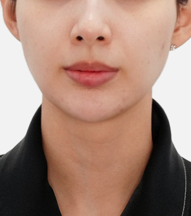 시술 후